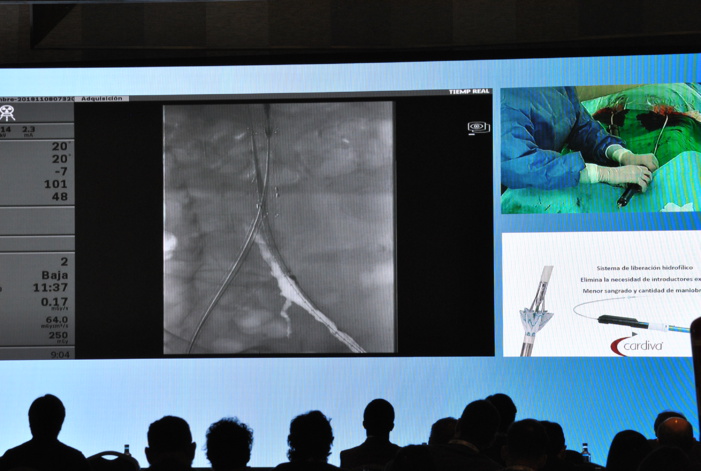 NOTA DE PRENSA/BILBAO: EL HOSPITAL DE BASURTO RETRANSMITE EN DIRECTO A MÁS 200 CIRUJANOS ENDOVASCULARES DE TODA ESPAÑA UNA INTERVENCIÓN DE AORTA ABDOMINAL CON NOVEDOSA ENDOPRÓTESIS NOTA DE PRENSA/BILBAO: EL HOSPITAL DE BASURTO RETRANSMITE EN DIRECTO A MÁS 200 CIRUJANOS ENDOVASCULARES DE TODA ESPAÑA UNA INTERVENCIÓN DE AORTA ABDOMINAL CON NOVEDOSA ENDOPRÓTESIS