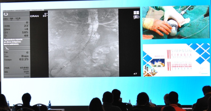 NOTA DE PRENSA/BURGOS: EL HOSPITAL DE BURGOS IMPLANTA UN NOVEDOSO STENT PARA TRATAR EL ANEURISMA DE AORTA ABDOMINAL NOTA DE PRENSA/BURGOS: EL HOSPITAL DE BURGOS IMPLANTA UN NOVEDOSO STENT PARA TRATAR EL ANEURISMA DE AORTA ABDOMINAL