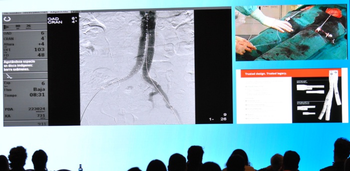 NOTA DE PRENSA/BURGOS: EL HOSPITAL DE BURGOS IMPLANTA UN NOVEDOSO STENT PARA TRATAR EL ANEURISMA DE AORTA ABDOMINAL NOTA DE PRENSA/BURGOS: EL HOSPITAL DE BURGOS IMPLANTA UN NOVEDOSO STENT PARA TRATAR EL ANEURISMA DE AORTA ABDOMINAL