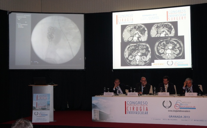 NOTA DE PRENSA: Cirugía endovascular de 'alta costura' y a 'medida' del paciente, desde el Hospital San Cecilio de Granada NOTA DE PRENSA: Cirugía endovascular de 'alta costura' y a 'medida' del paciente, desde el Hospital San Cecilio de Granada